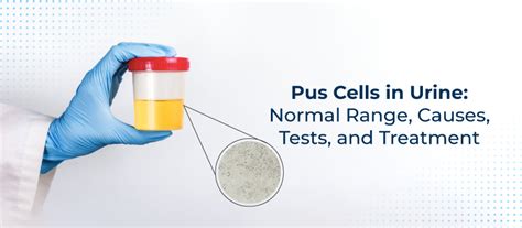 pus cells in urine normal value|Pus Cells in Urine: Normal Range, Causes, .